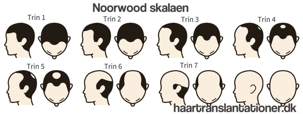 Norwood skalaen hårtab mænd